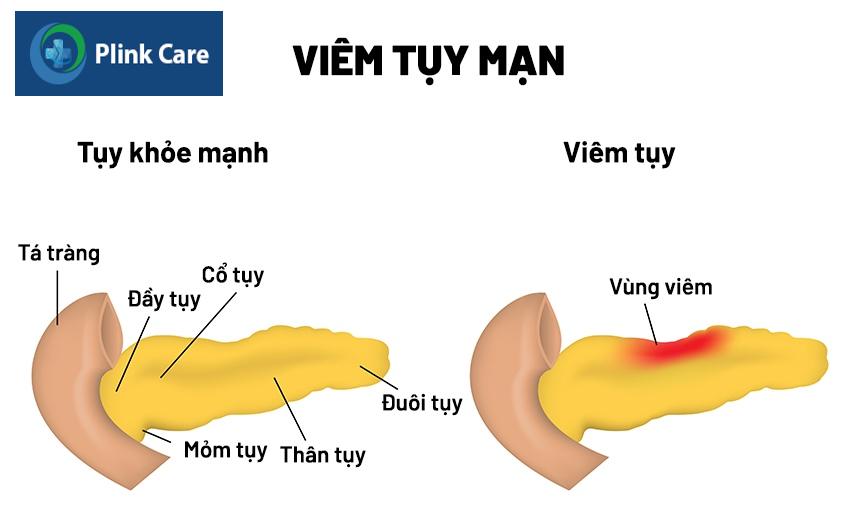 viêm tụy mãn tính