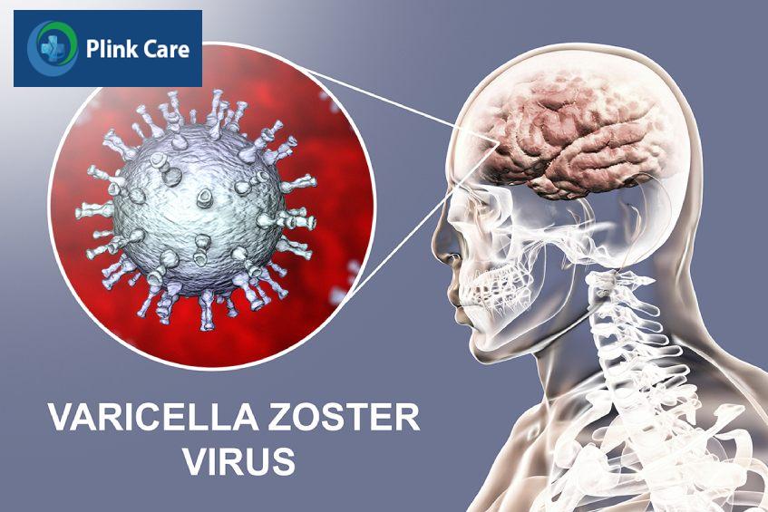 Virus thủy đậu có thể tấn công đến hệ thần kinh