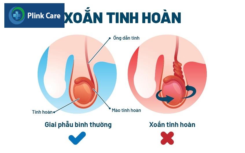 xoắn tinh hoàn
