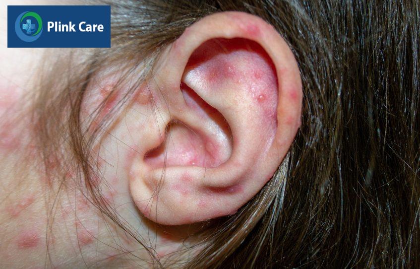 bệnh thủy đậu tiềm ẩn nhiều biến chứng nào