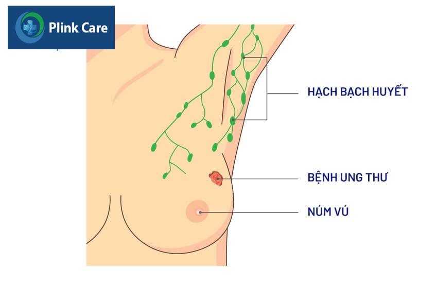 Các loại ung thư vú phổ biến