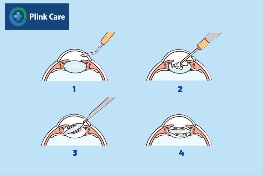 Các phương pháp mổ đục thủy tinh thể