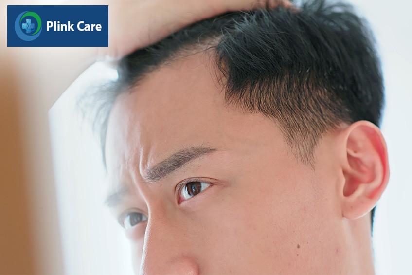 căng thẳng stress nguyên nhân gây hói đầu