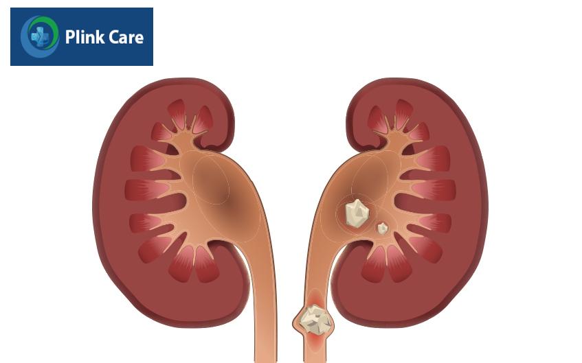 chỉ định và chống chỉ định khi dặt sonde jj