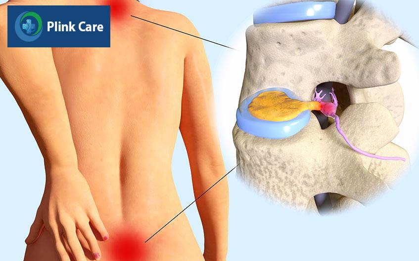 cơn đau ở vùng cổ và vùng thắt lưng