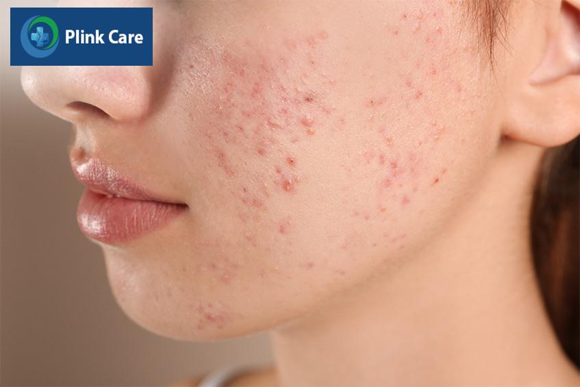 Dấu hiệu nhận biết mụn nội tiết
