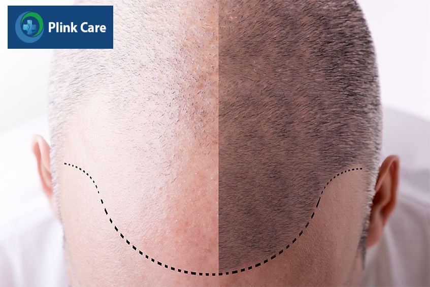 dấu hiệu nhận biết rụng tóc ở nam giới