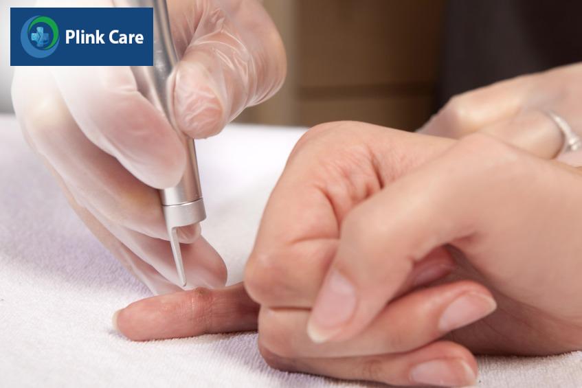điều trị mụn cóc sao cho hiệu quả