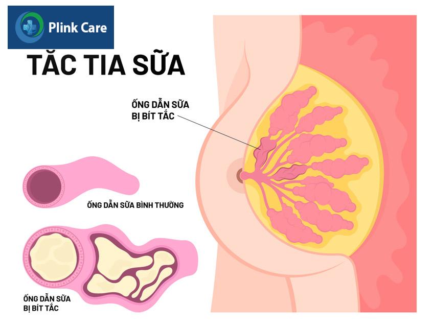 hiện tượng tắc sữa sau sinh