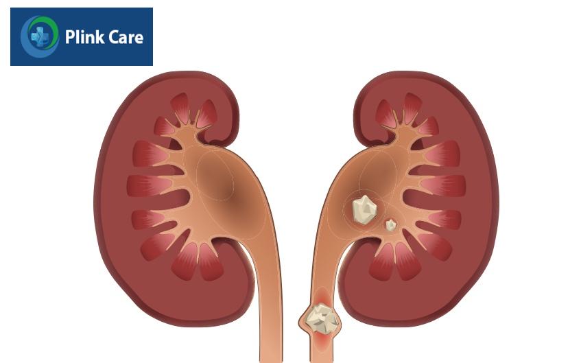 khi nào nên đặt stent niệu quản