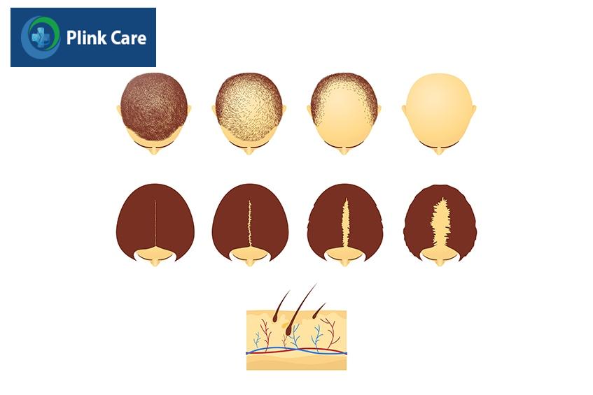 khi nào cần điều trị hói đầu
