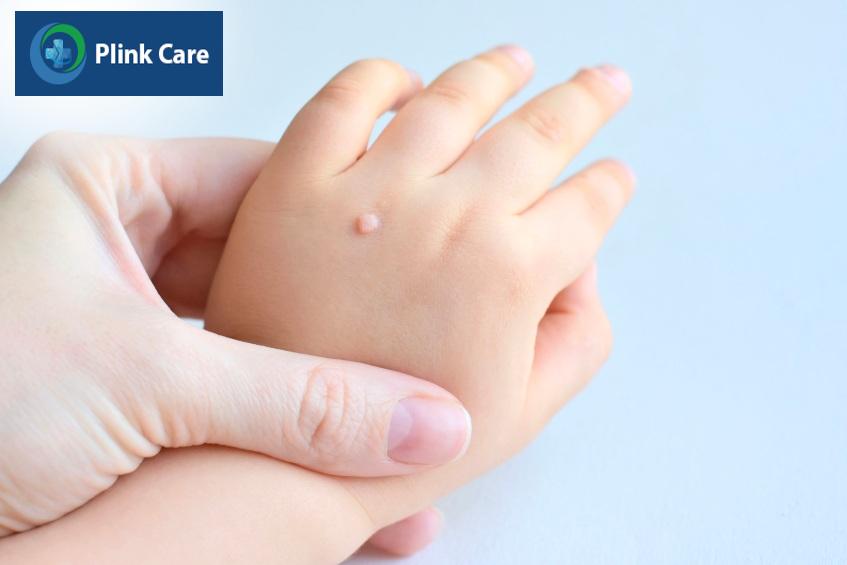 mụn cóc có tự rụng không
