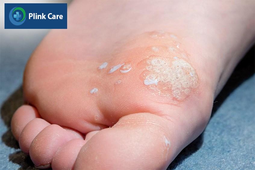 mụn cóc ghép mảnh