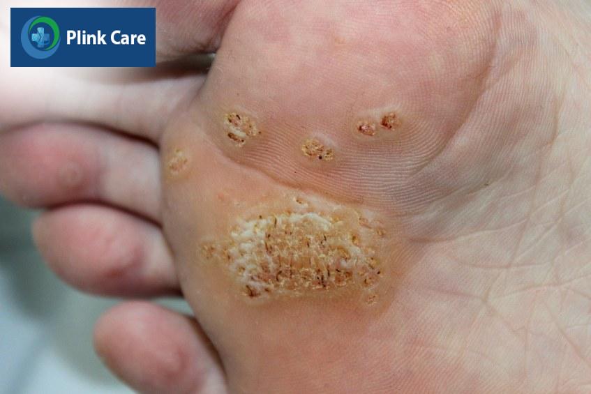 Mụn cóc Plantar