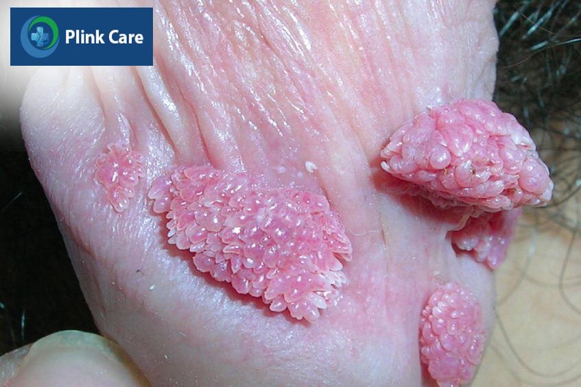 mụn cóc sinh dục
