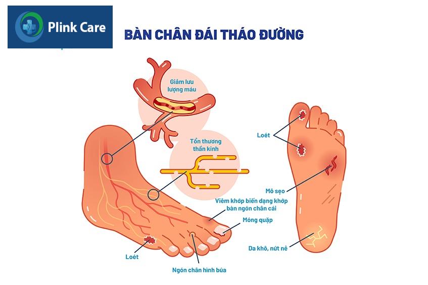 nhiễm trùng bàn chân đái tháo đường