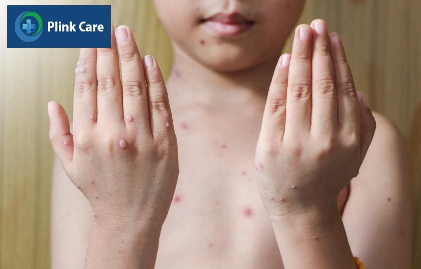 Nốt thủy đậu mọc khắp cơ thể của trẻ