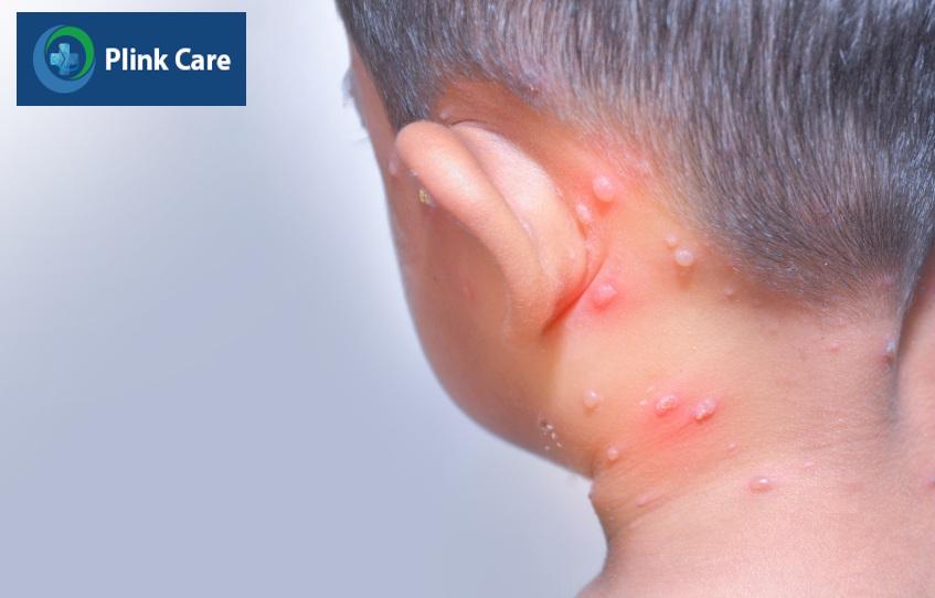 Nốt thủy đậu xuất hiện khắp cơ thể của trẻ