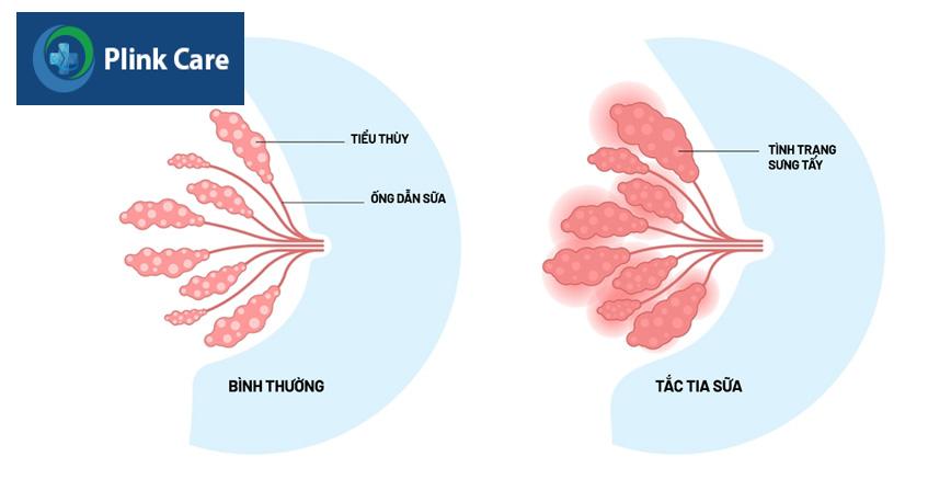 ống dẫn sữa bị bít tắc