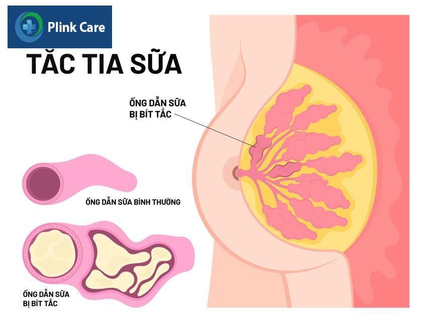 ống dẫn sữa bị tắc