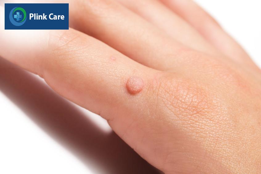 phát hiện mụn cóc nên làm gì