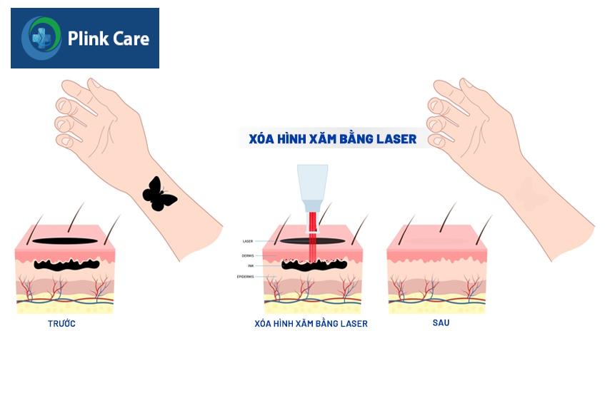 phương pháp xóa xăm phổ biến