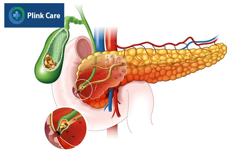 sỏi mật có tán được không