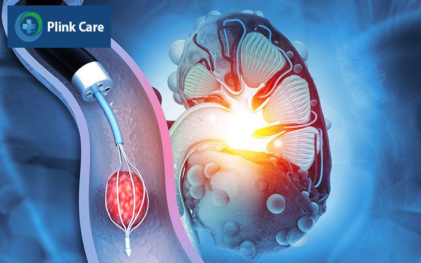 sỏi niệu quản có chữa được không