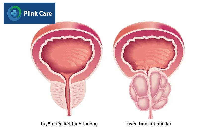 tăng sinh lành tính tuyến tiền liệt là bệnh gì