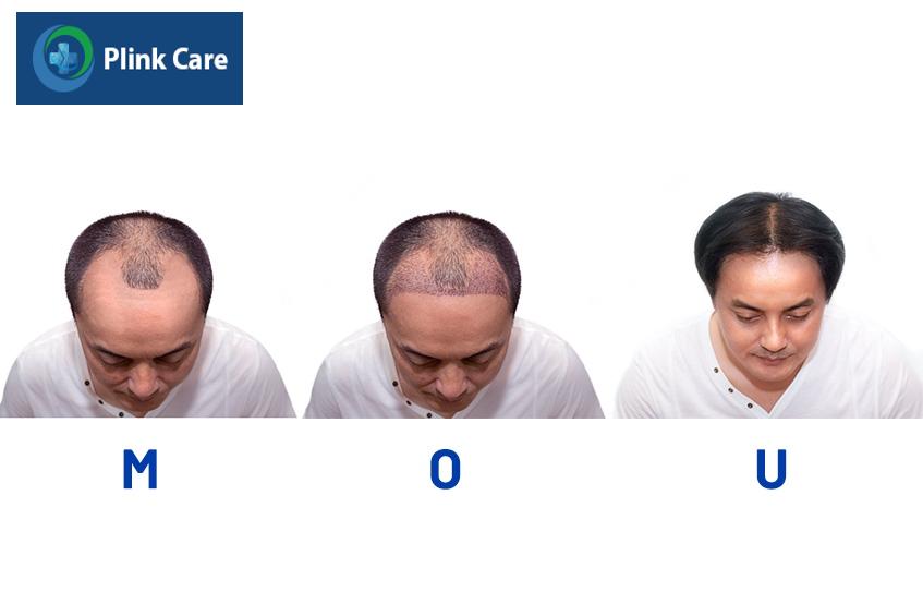 thờng xuyên massage đầu