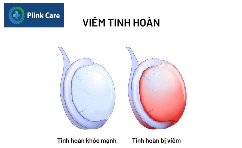 tinh hoàn bị viêm