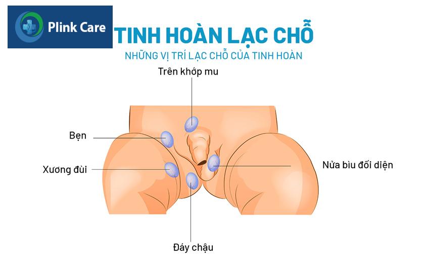 tinh hoàn không đúng vị trí