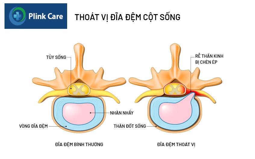 tình trạng thoát vị ở cột sống