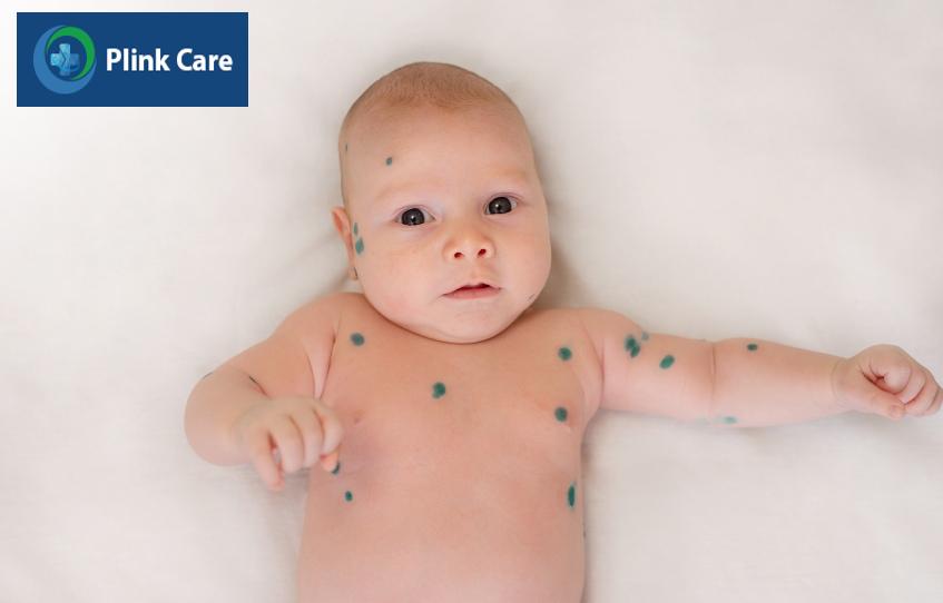 Trẻ được bôi thuốc xanh Methylen tại các nốt thủy đậu