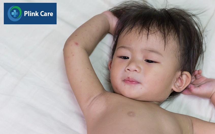 Trẻ lờ đờ, mệt mỏi, sốt cao do tay chân miệng cấp độ 2