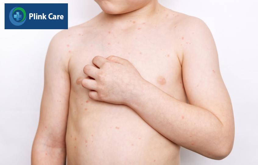 tuyệt đối không cho trẻ gãi ngứa ở các nốt thủy đậu