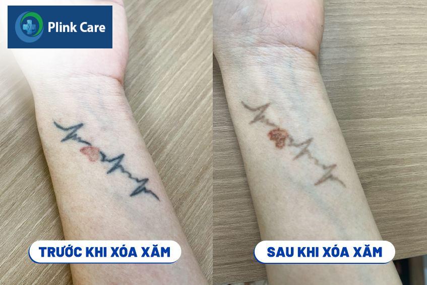 xóa xăm laser hạn chế để lại sẹo