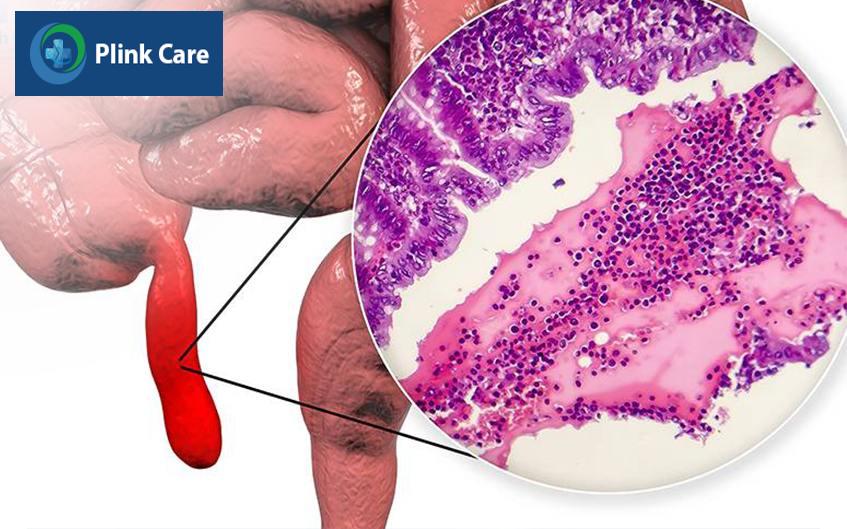 bị viêm phúc mạc ruột thừa