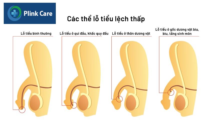 các thể lỗ tiểu lệch thấp