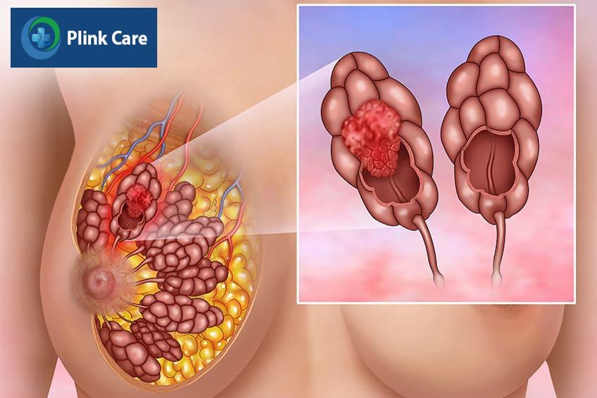 Các yếu tố nguy cơ mắc ILC