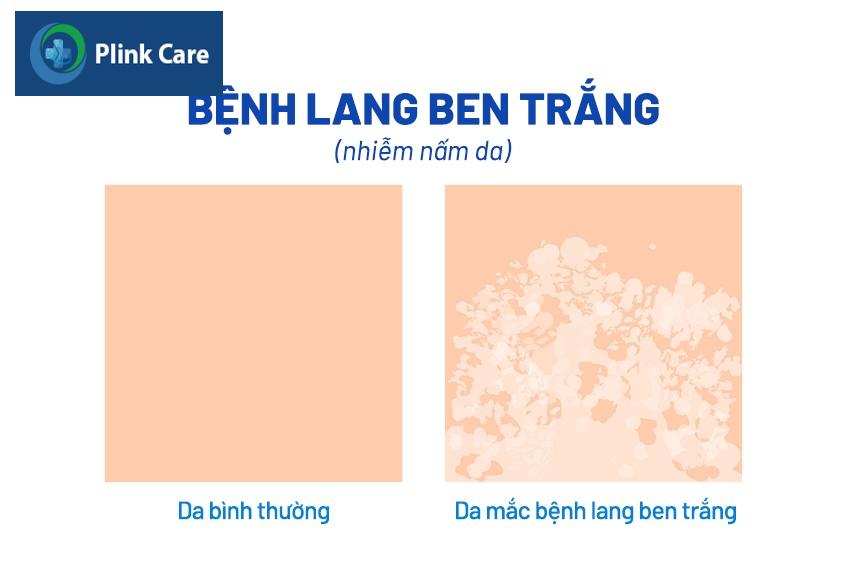 cách chữa lang ben trắng hiệu quả