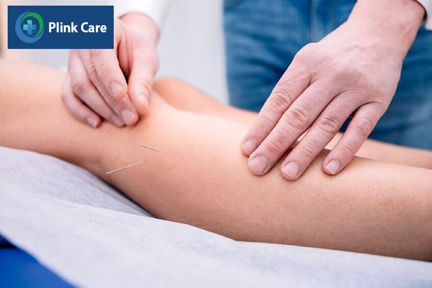 châm cứu điều trị bệnh viêm dây thần kinh