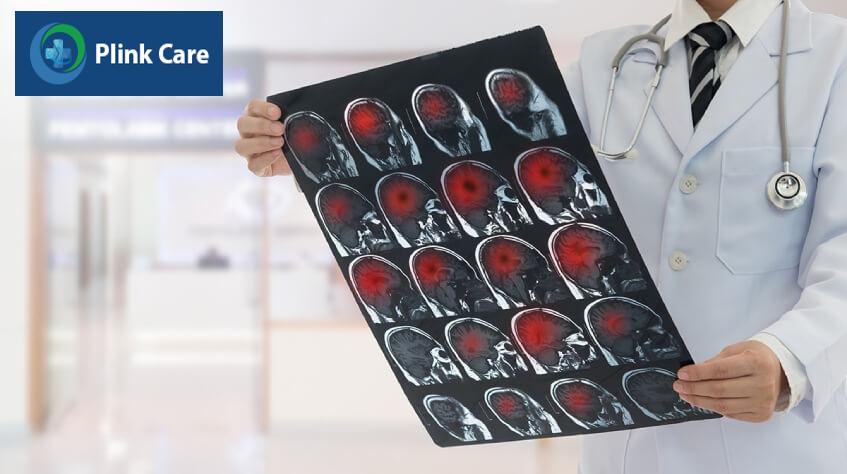 chẩn đoán cơn thiếu máu não thoáng qua tia