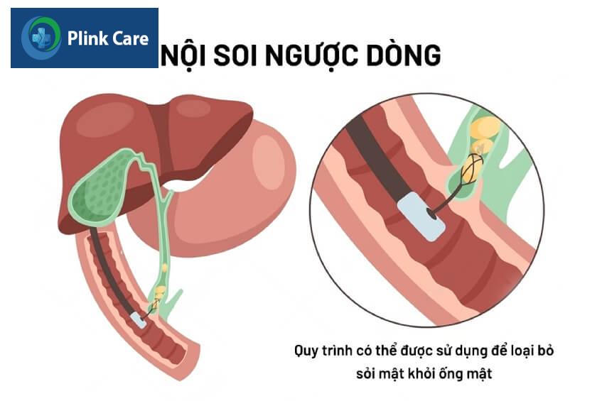 chẩn đoán ung thư tụy