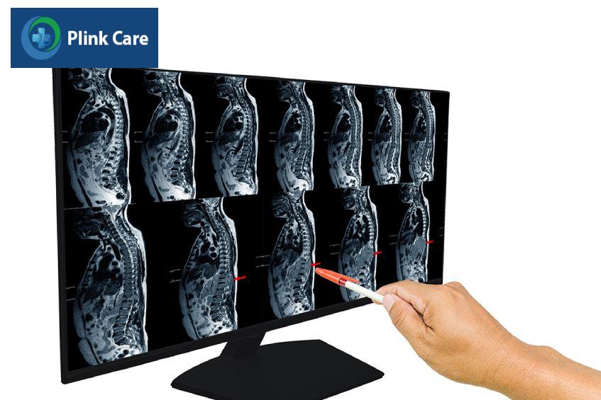 chỉ định chụp mri cột sống