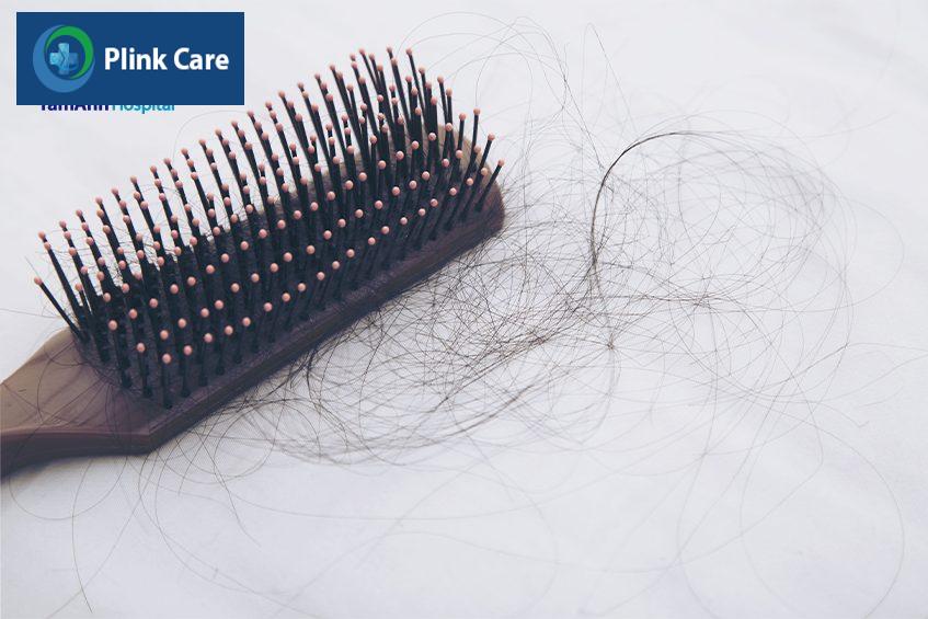 dấu hiệu rụng tóc gây hói đầu