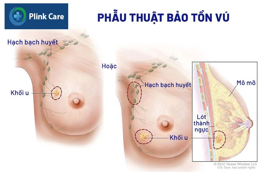 Đối tượng không chỉ định mổ bảo tồn vú