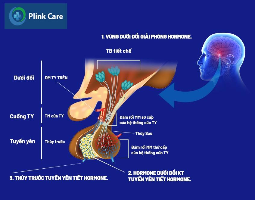 Đột quỵ tuyến yên xảy ra đột ngột