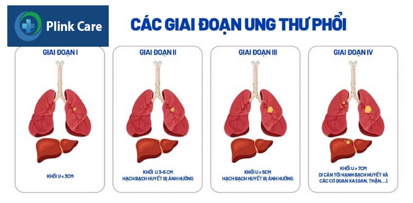 giai đoạn 4 trong các giai đoạn ung thư phổi