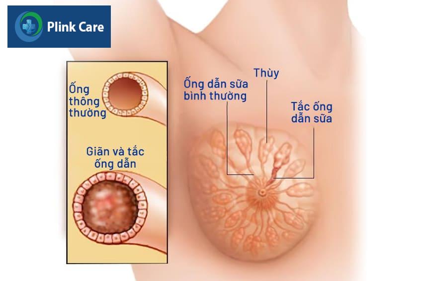 Giãn ống dẫn sữa có nguy hiểm không